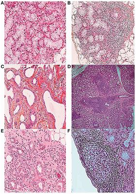 Recent Advances of Salivary Gland Biopsy in Sjögren's Syndrome